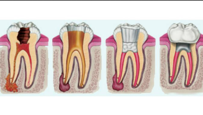 cara mengatasi sakit gigi berlubang tanpa obat akar gigi